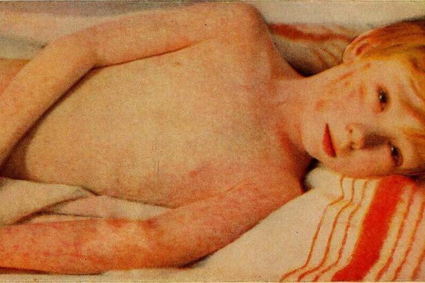 Child with measles lying on his side