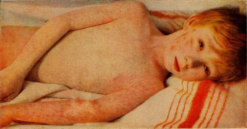 Child with measles lying on his side