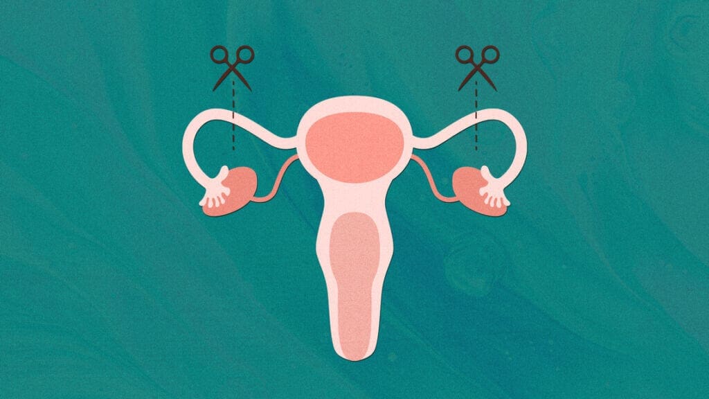 Illustration of tubal ligation