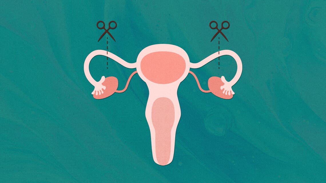 Illustration of tubal ligation